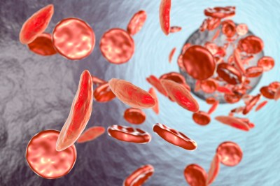 Sickle cell anaemia, illustration